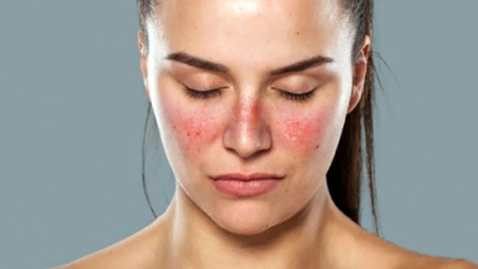 Lupus